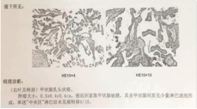 別慌，甲狀腺疾病還可以這樣投保！