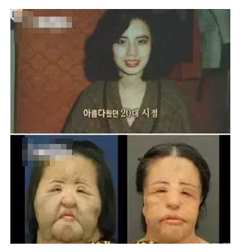 整容發(fā)生意外保險賠嗎？